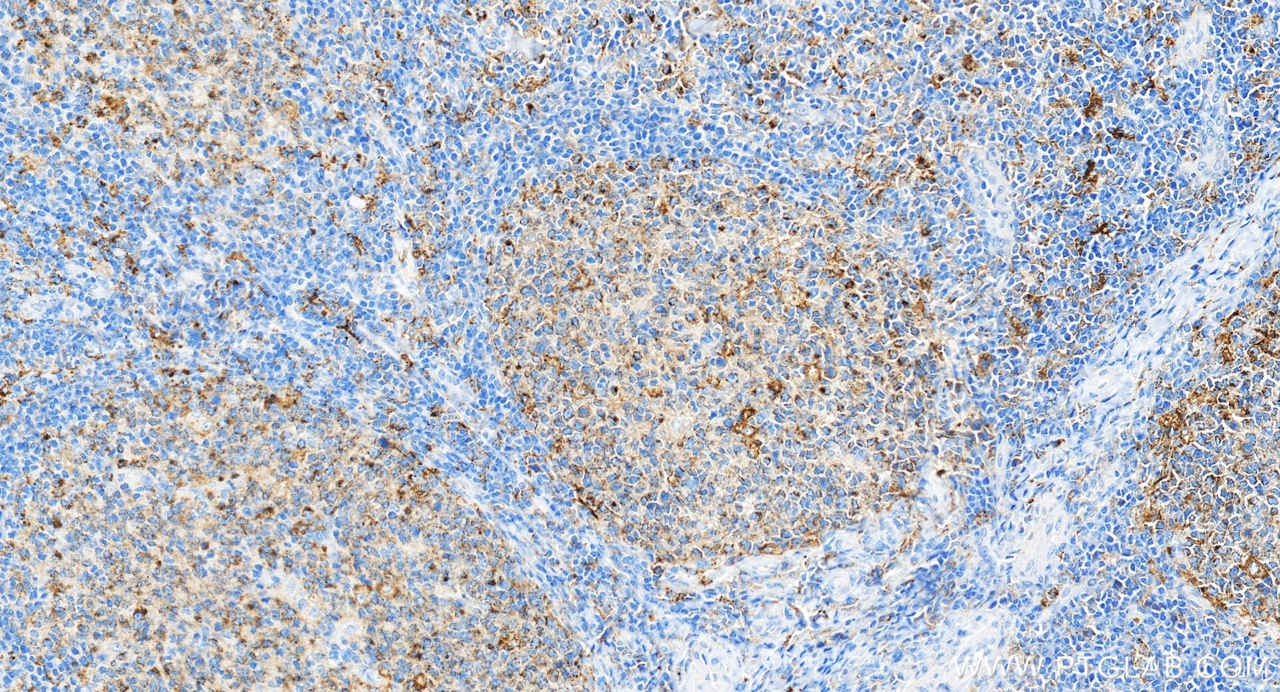 IHC staining of human tonsillitis using 81793-14-RR