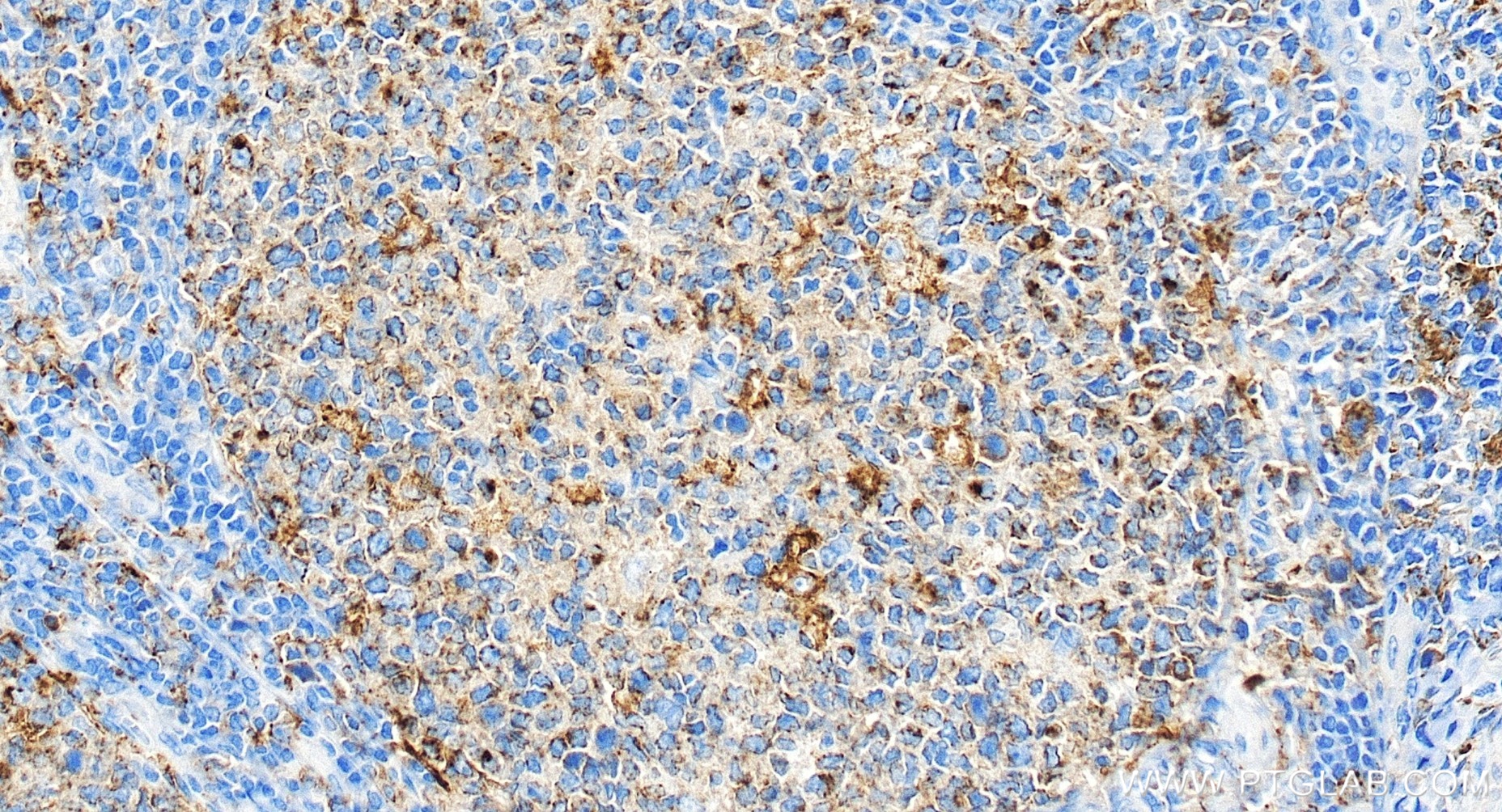 IHC staining of human tonsillitis using 81793-14-RR (same clone as 81793-14-PBS) IHC staining of human tonsillitis using 81793-14-RR (same clone as 81793-14-PBS)