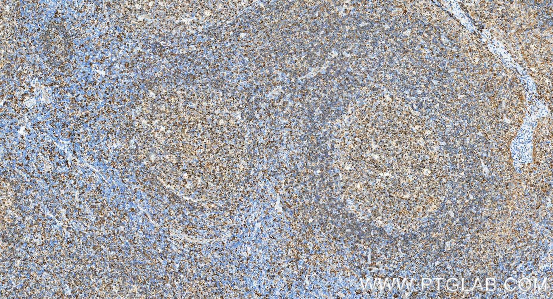 IHC staining of human tonsillitis using 98478-2-RR