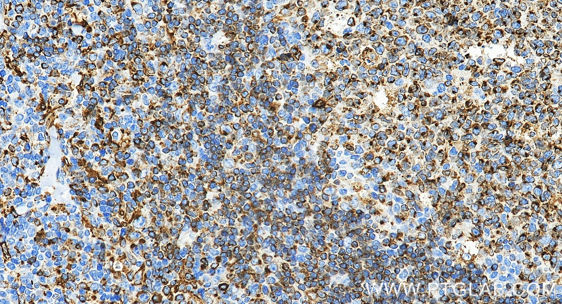 IHC staining of human tonsillitis using 98478-2-RR