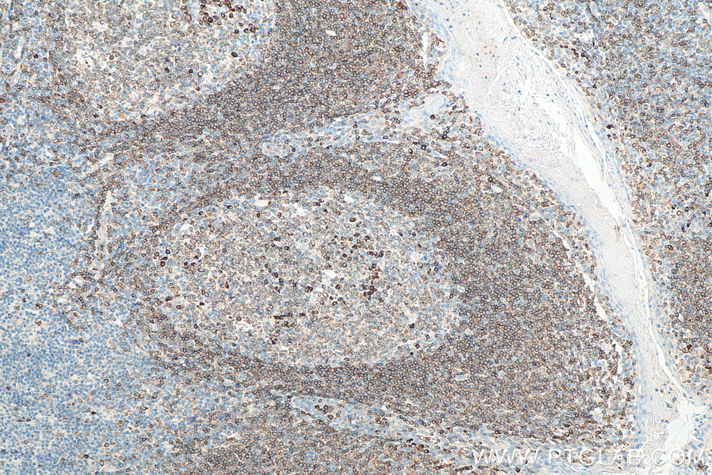 IHC staining of human tonsillitis using 22349-1-AP