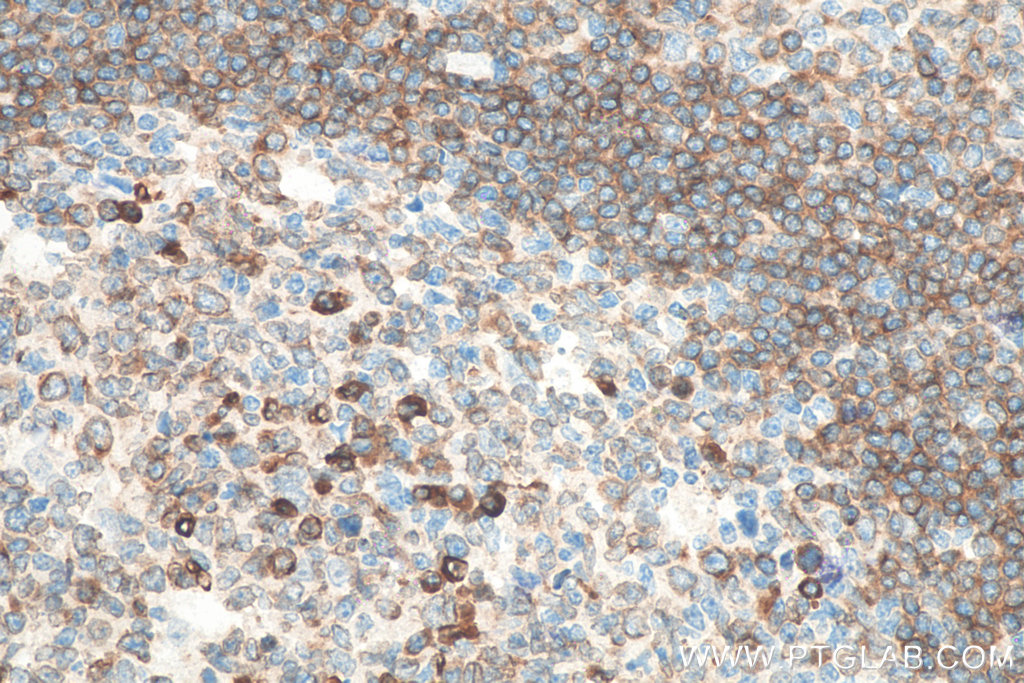 IHC staining of human tonsillitis using 22349-1-AP