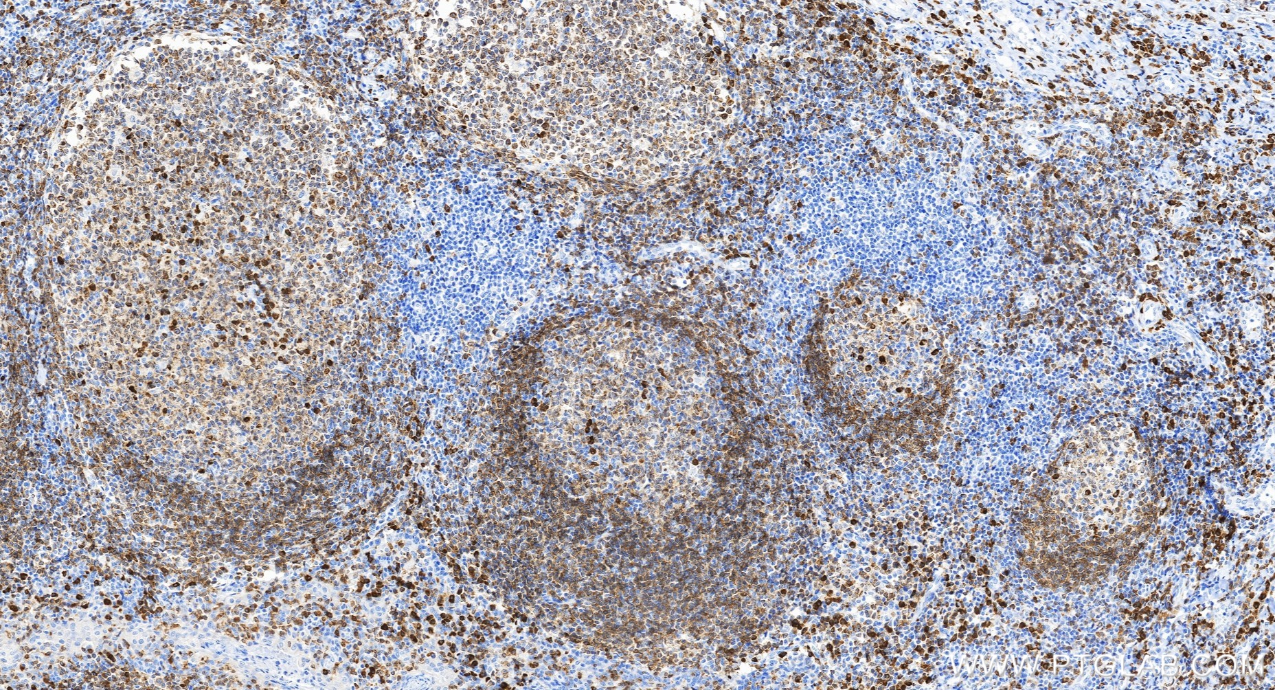 IHC staining of human tonsillitis using 82747-6-RR IHC staining of human tonsillitis using 82747-6-RR