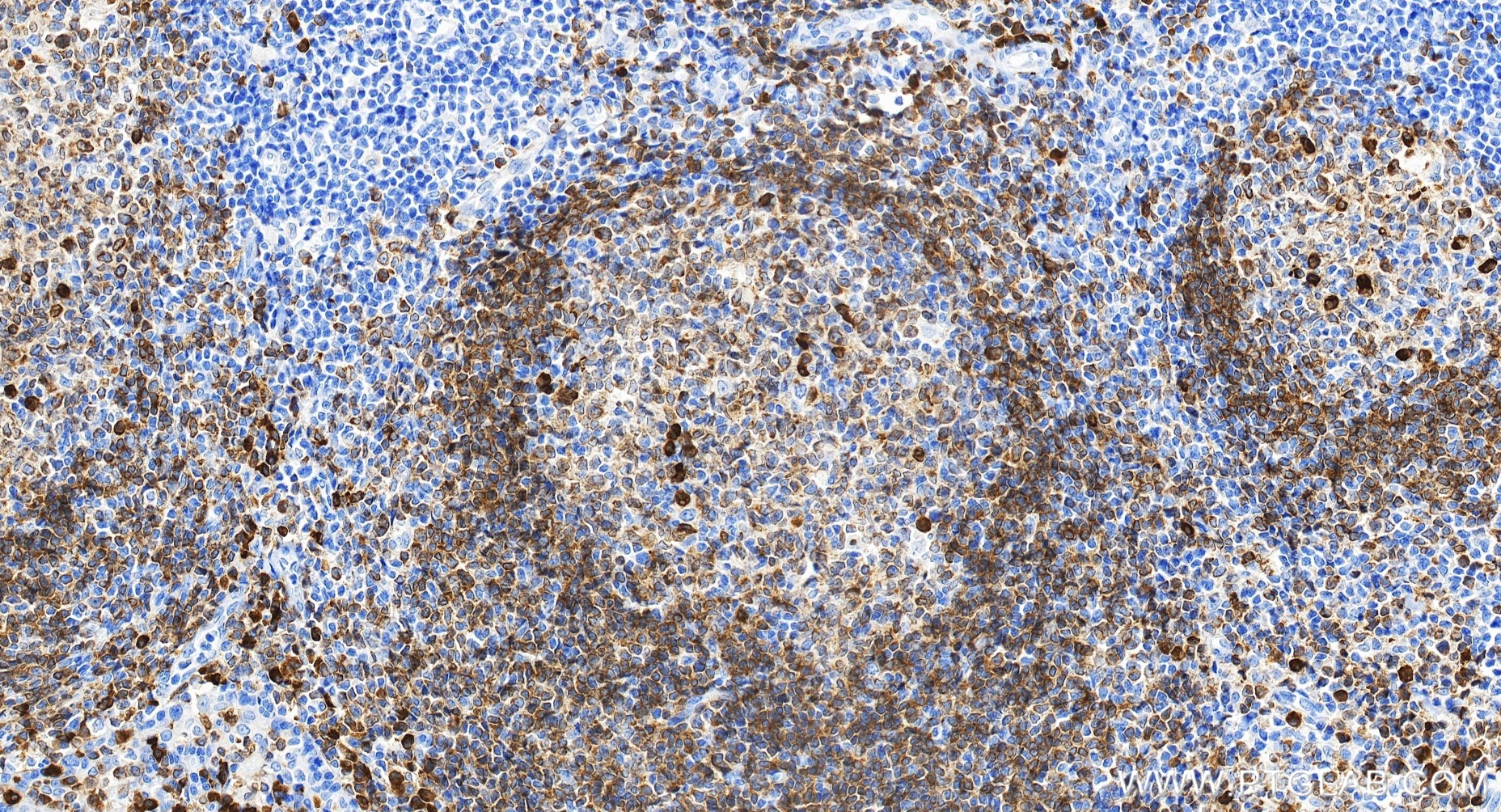 IHC staining of human tonsillitis using 82747-6-RR IHC staining of human tonsillitis using 82747-6-RR