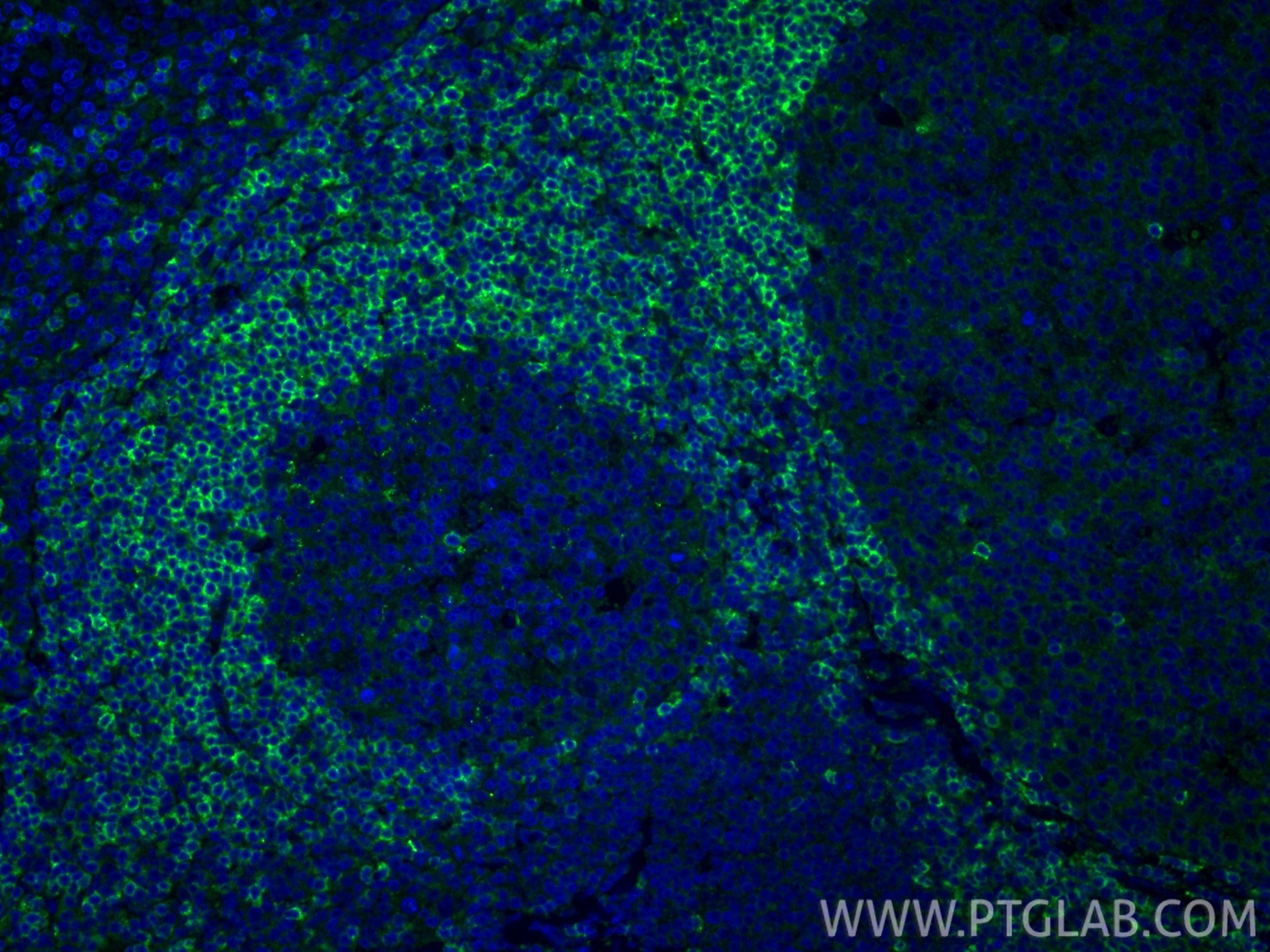 IF Staining of human tonsillitis using 21063-1-AP