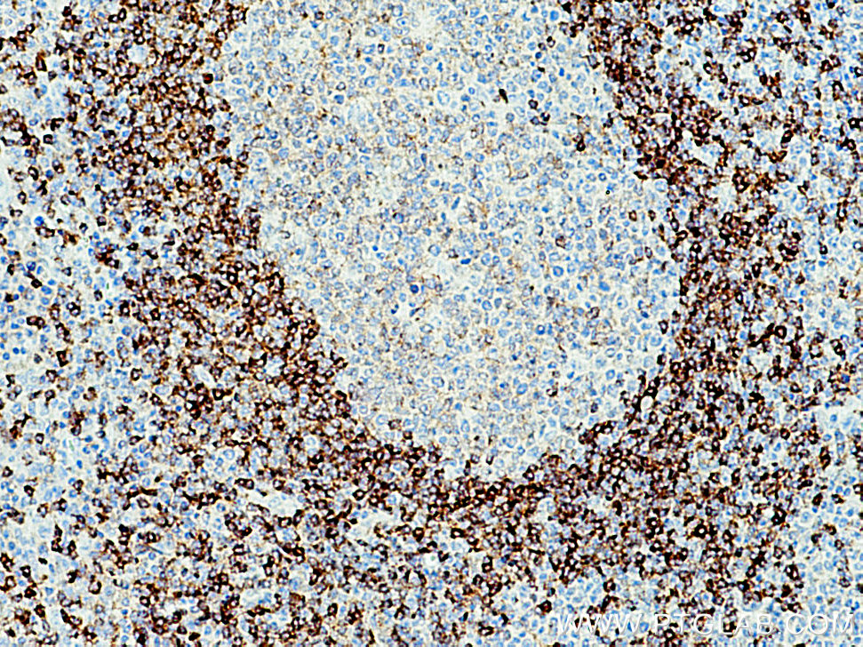 IHC staining of human tonsillitis using 21063-1-AP