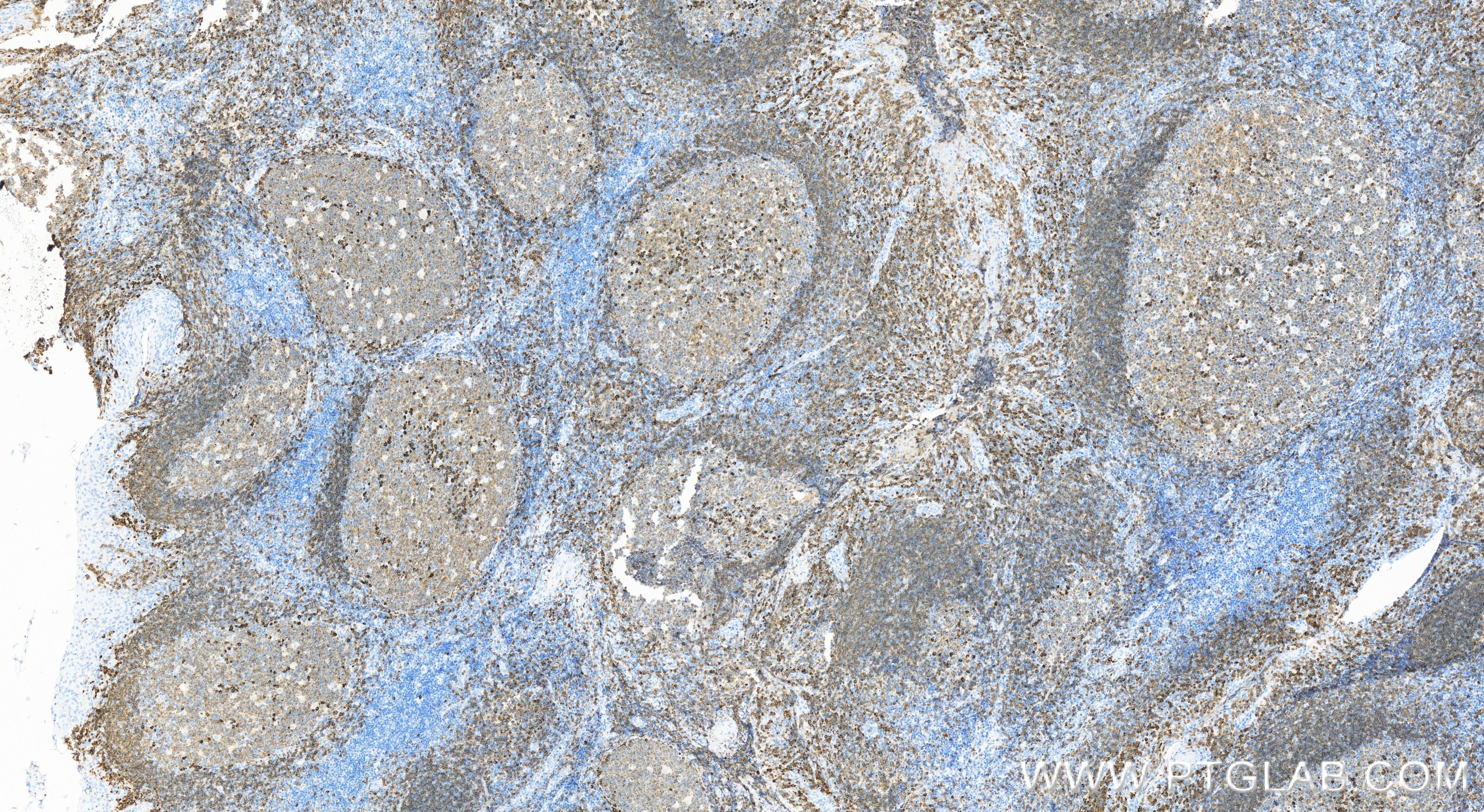 IHC staining of human tonsillitis using 84236-4-RR