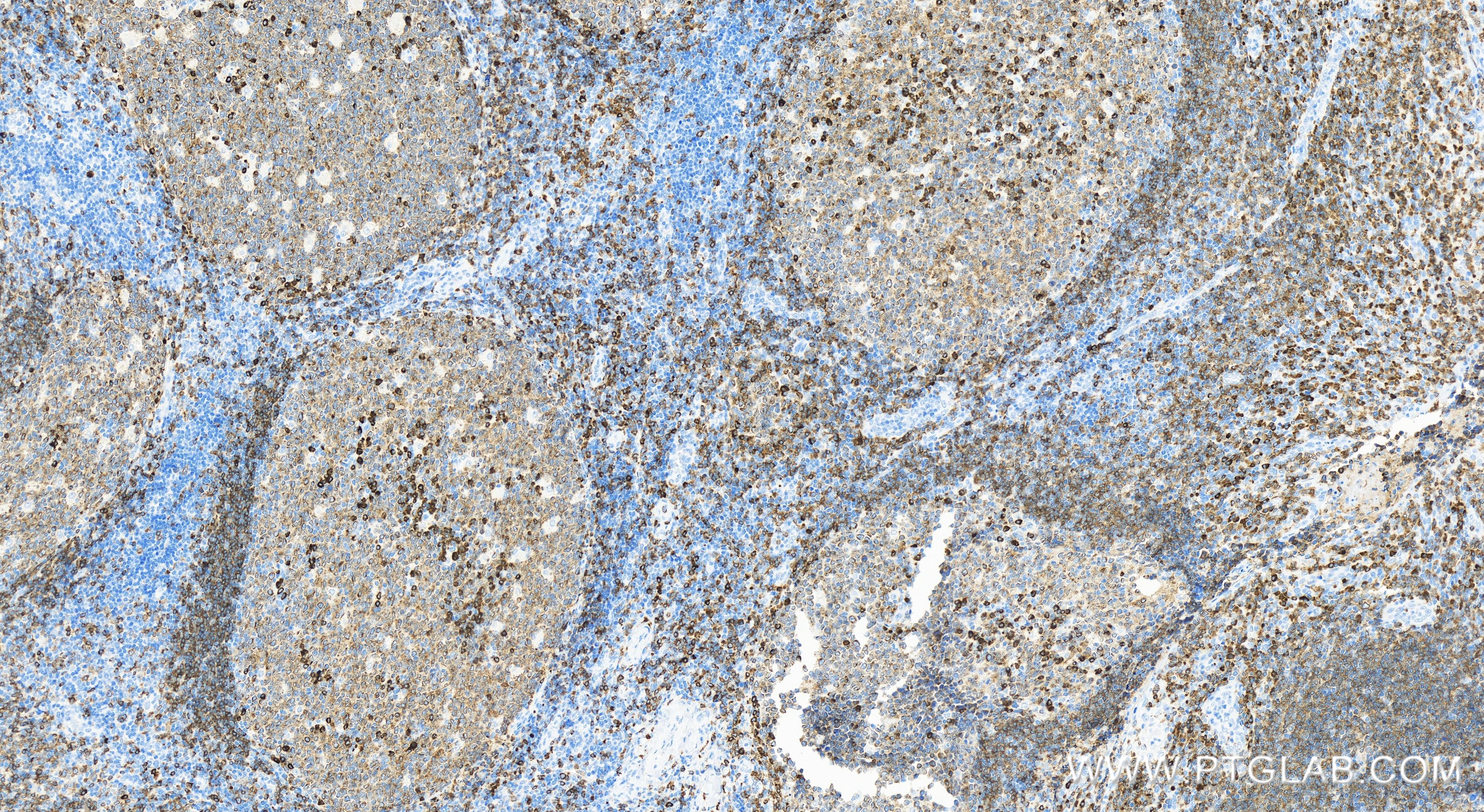 IHC staining of human tonsillitis using 84236-4-RR