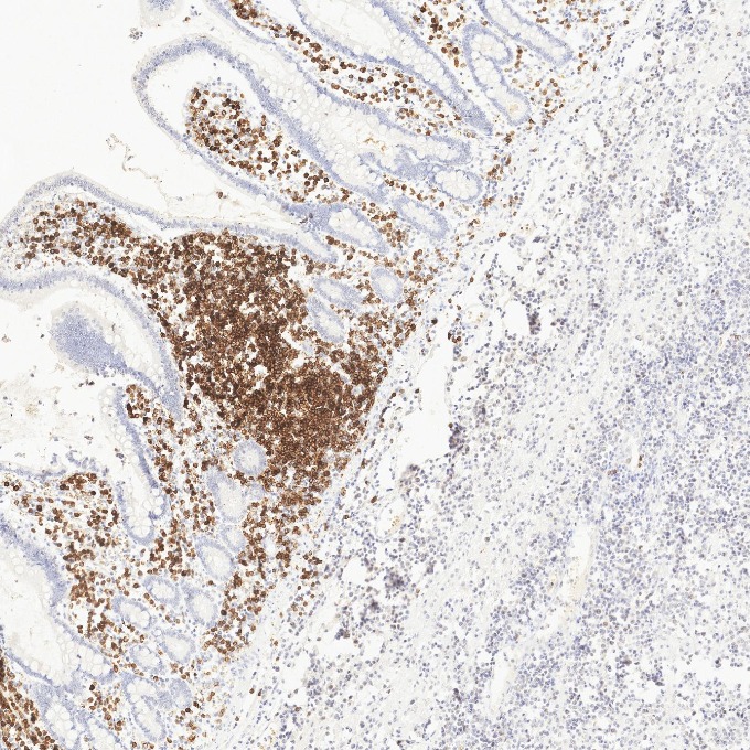 IHC staining of human lymphoma using 84236-4-RR IHC staining of human lymphoma using 84236-4-RR