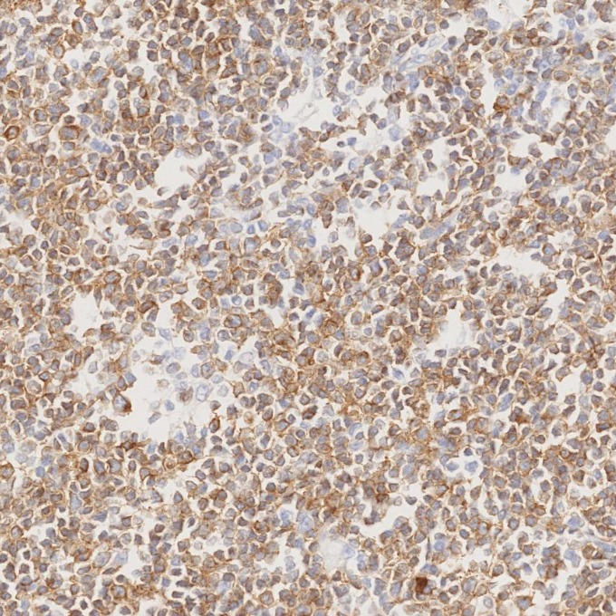 IHC staining of human lymphoma using 84236-4-RR IHC staining of human lymphoma using 84236-4-RR