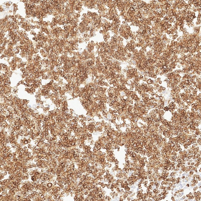 IHC staining of human lymphoma using 84236-4-RR IHC staining of human lymphoma using 84236-4-RR