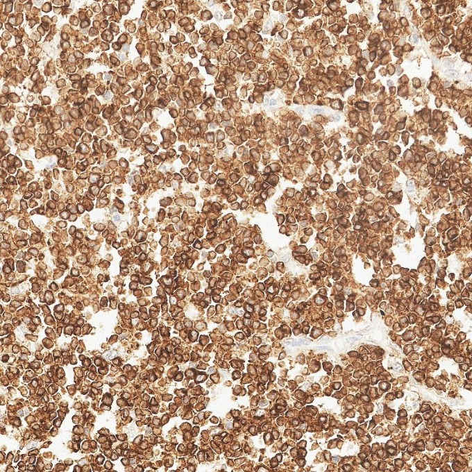 IHC staining of human lymphoma using 84236-4-RR IHC staining of human lymphoma using 84236-4-RR