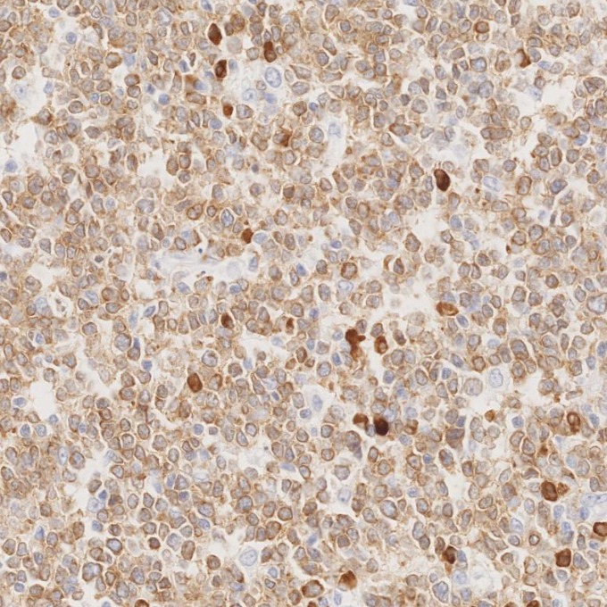 IHC staining of human lymphoma using 84236-4-RR IHC staining of human lymphoma using 84236-4-RR