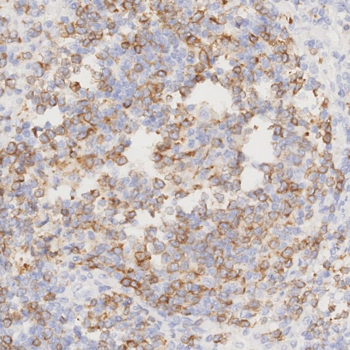 IHC staining of human lymphoma using 84236-4-RR IHC staining of human lymphoma using 84236-4-RR