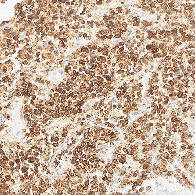 IHC staining of human lymphoma using 84236-4-RR IHC staining of human lymphoma using 84236-4-RR