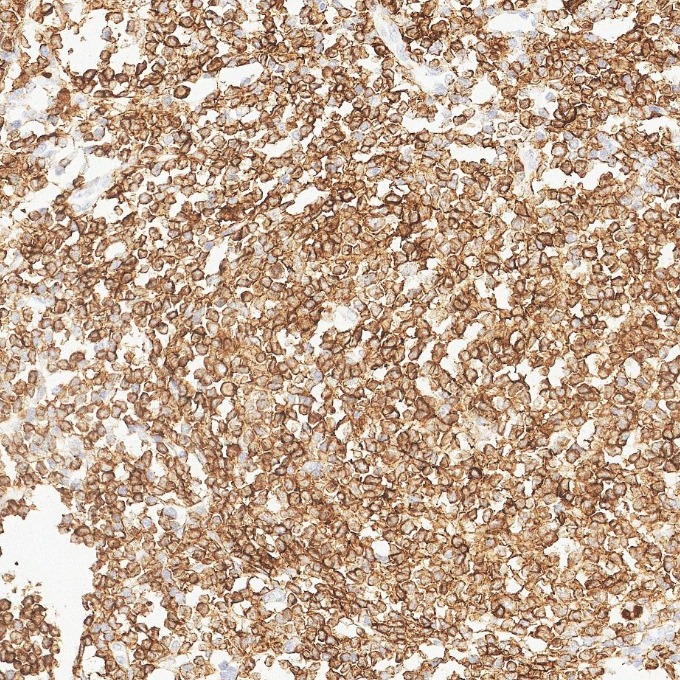 IHC staining of human lymphoma using 84236-4-RR IHC staining of human lymphoma using 84236-4-RR