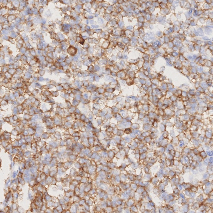 IHC staining of human lymphoma using 84236-4-RR IHC staining of human lymphoma using 84236-4-RR