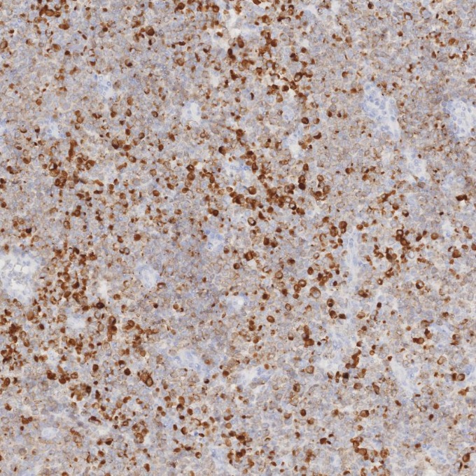 IHC staining of human lymphoma using 84236-4-RR IHC staining of human lymphoma using 84236-4-RR