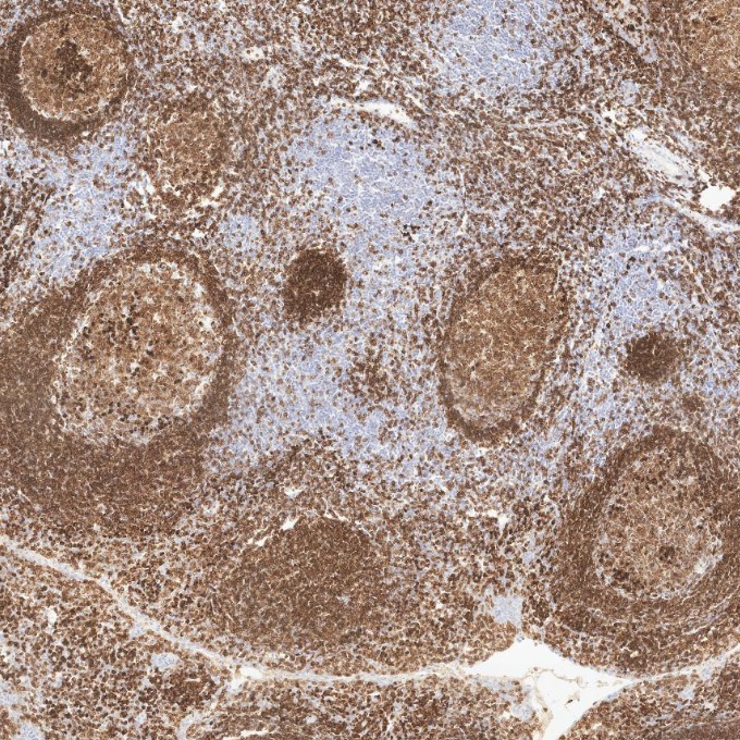IHC staining of human tonsillitis using 84236-4-RR IHC staining of human tonsillitis using 84236-4-RR