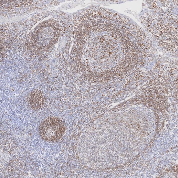IHC staining of human tonsillitis using 84236-4-RR IHC staining of human tonsillitis using 84236-4-RR