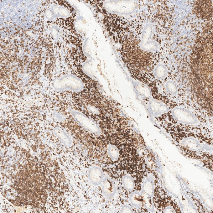 IHC staining of human appendicitis using 84236-4-RR IHC staining of human appendicitis using 84236-4-RR