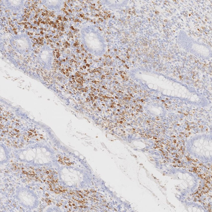IHC staining of human appendicitis using 84236-4-RR IHC staining of human appendicitis using 84236-4-RR