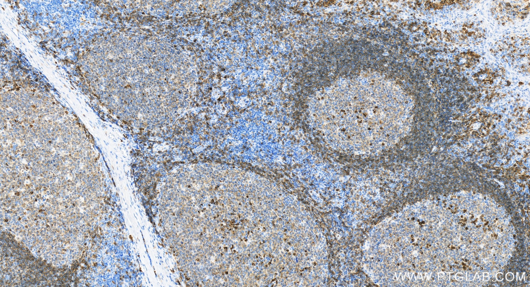 IHC staining of human tonsillitis using 84236-5-RR (same clone as 84236-5-PBS)