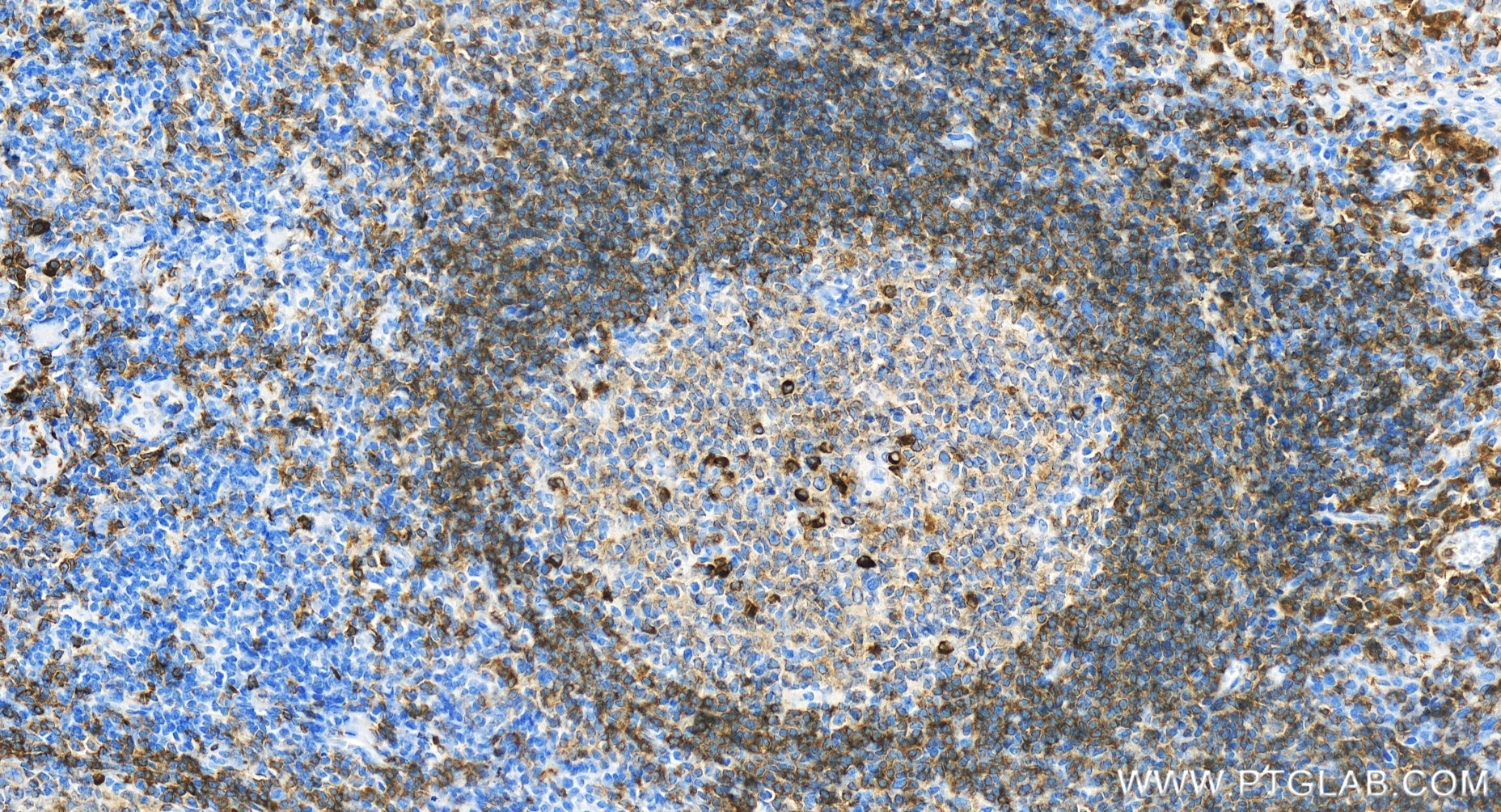 IHC staining of human tonsillitis using 84236-5-RR (same clone as 84236-5-PBS)