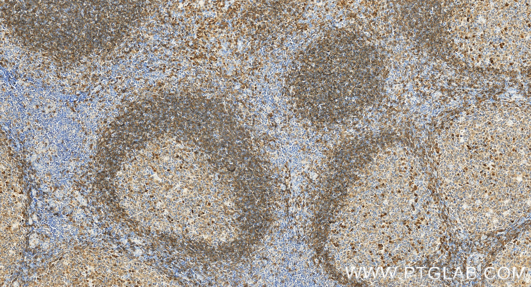 IHC staining of human tonsillitis using 98072-1-RR (same clone as 98072-1-PBS)