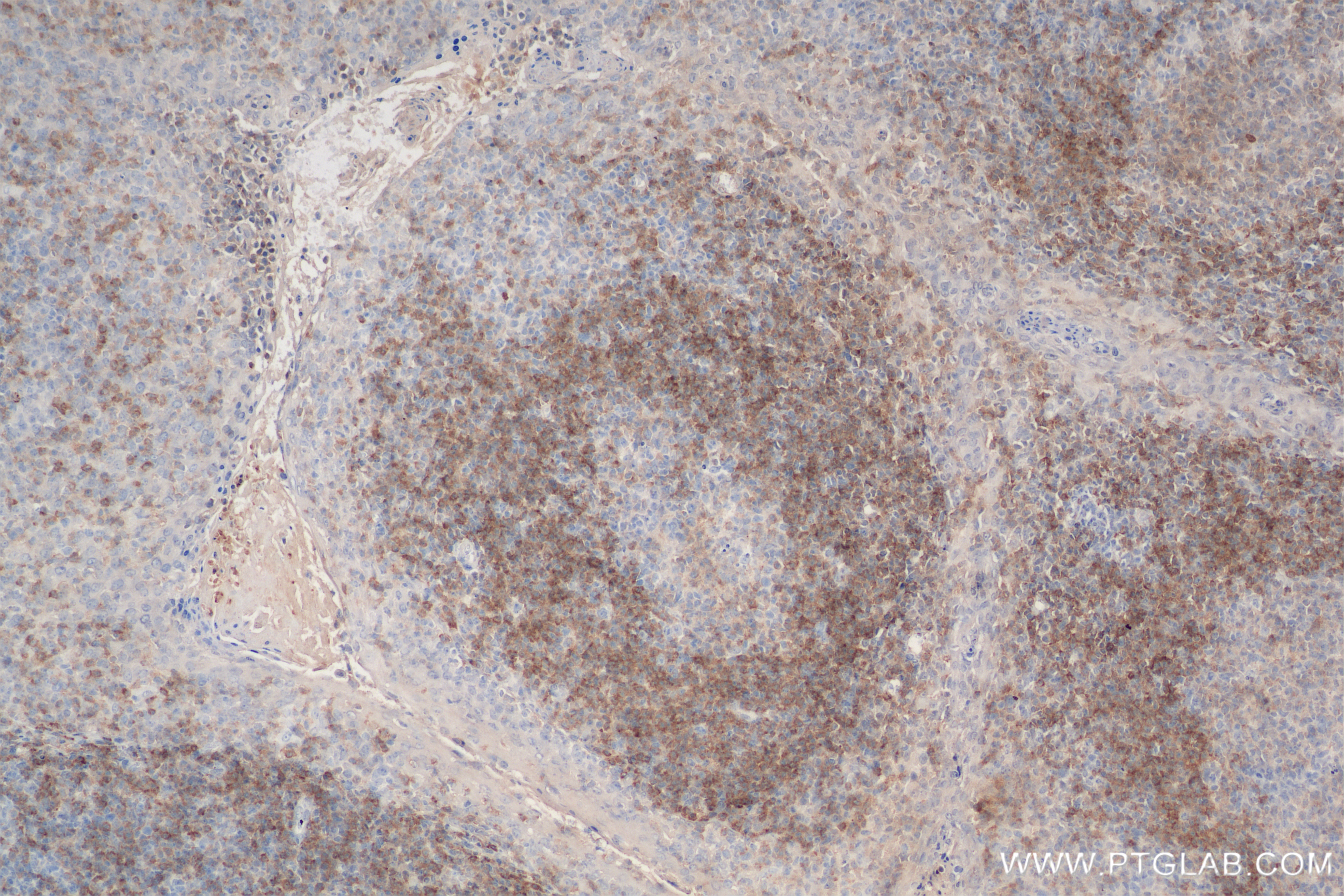 IHC staining of human tonsillitis using 84234-5-RR