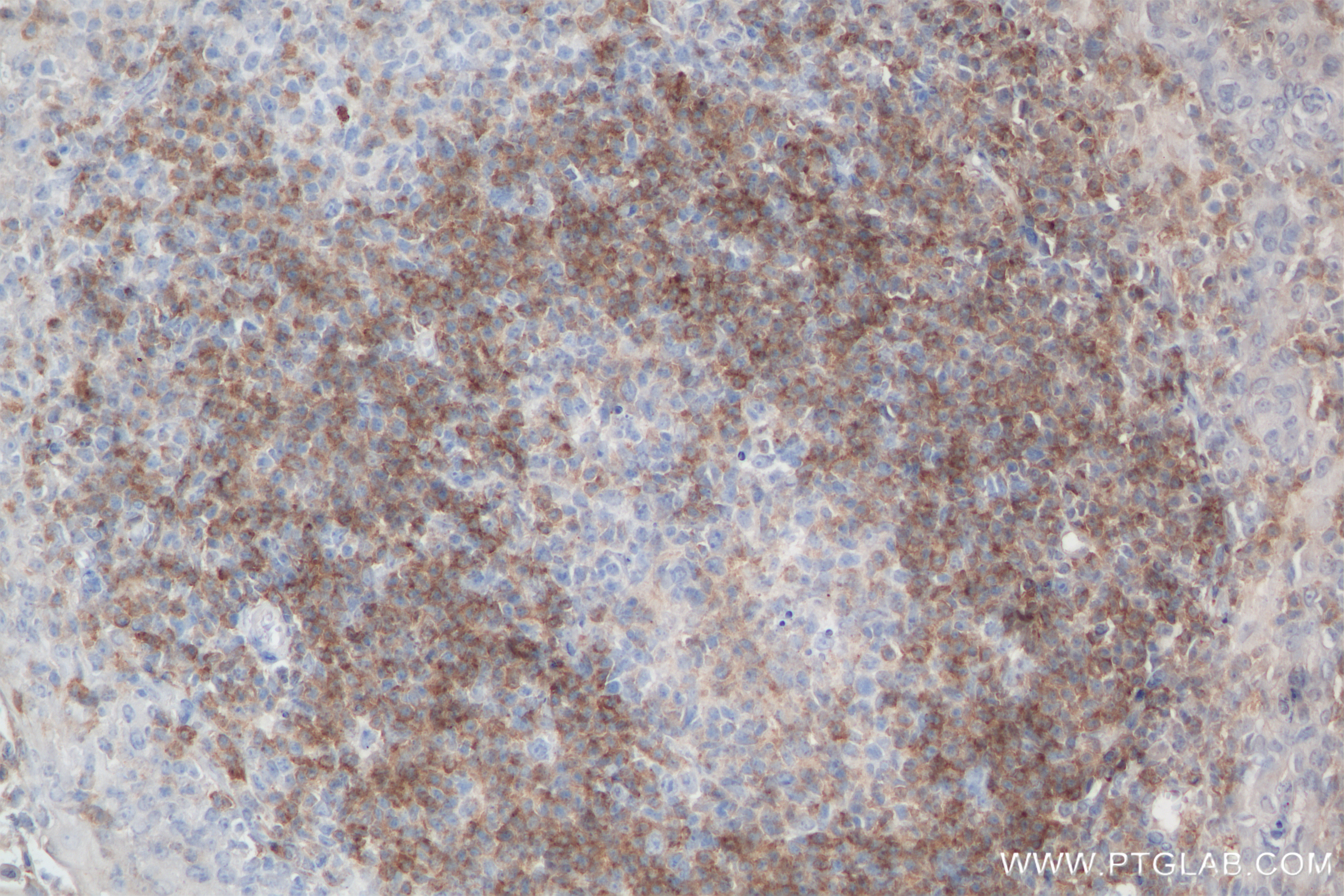IHC staining of human tonsillitis using 84234-5-RR
