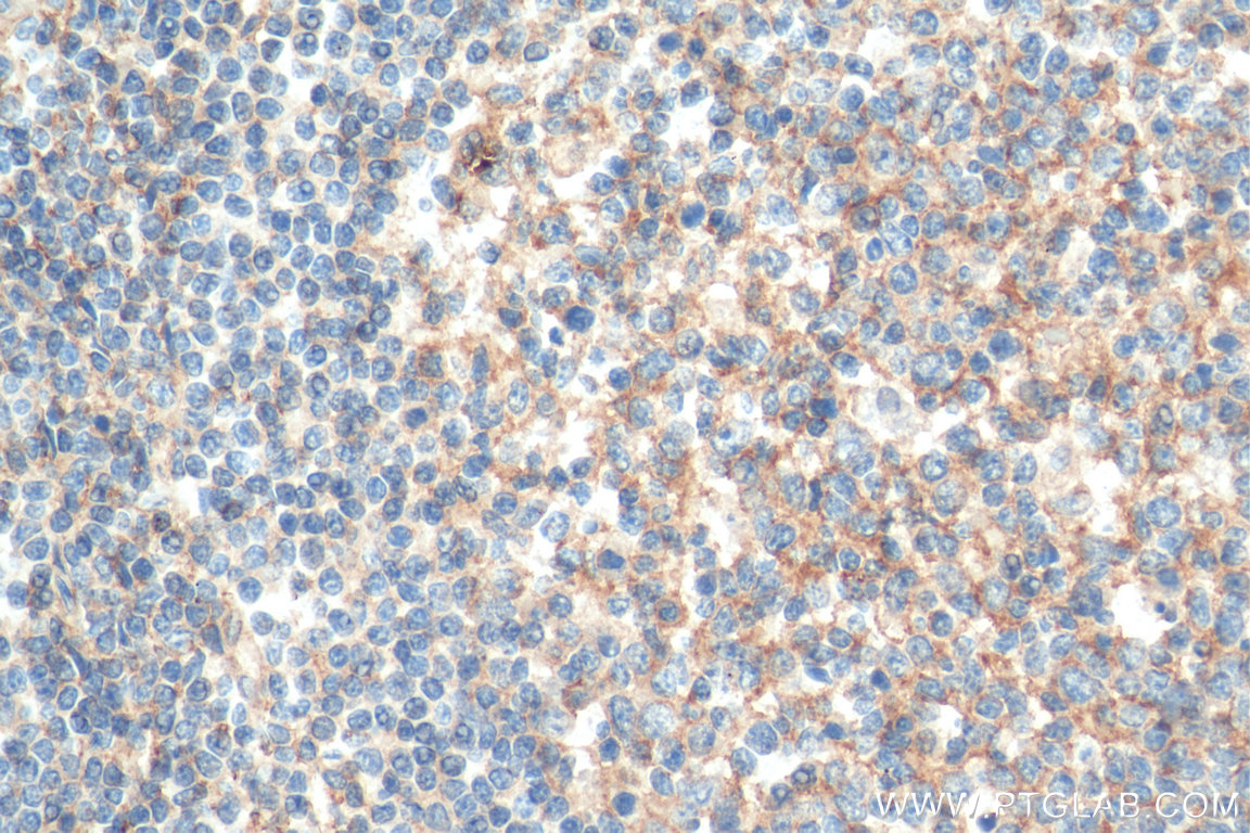IHC staining of human tonsillitis using 66866-1-Ig (same clone as 66866-1-PBS)