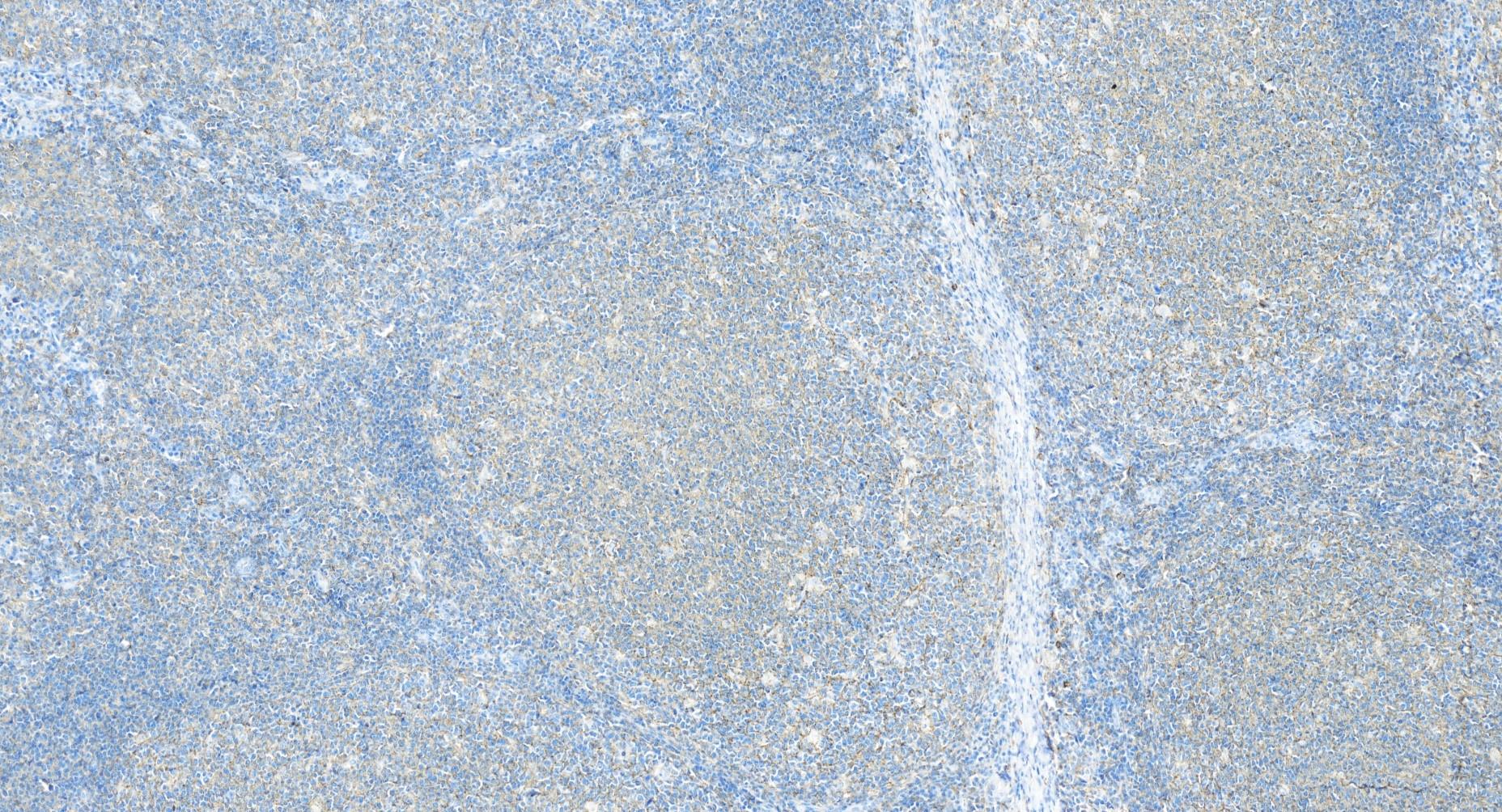 IHC staining of human tonsillitis using 84617-7-RR