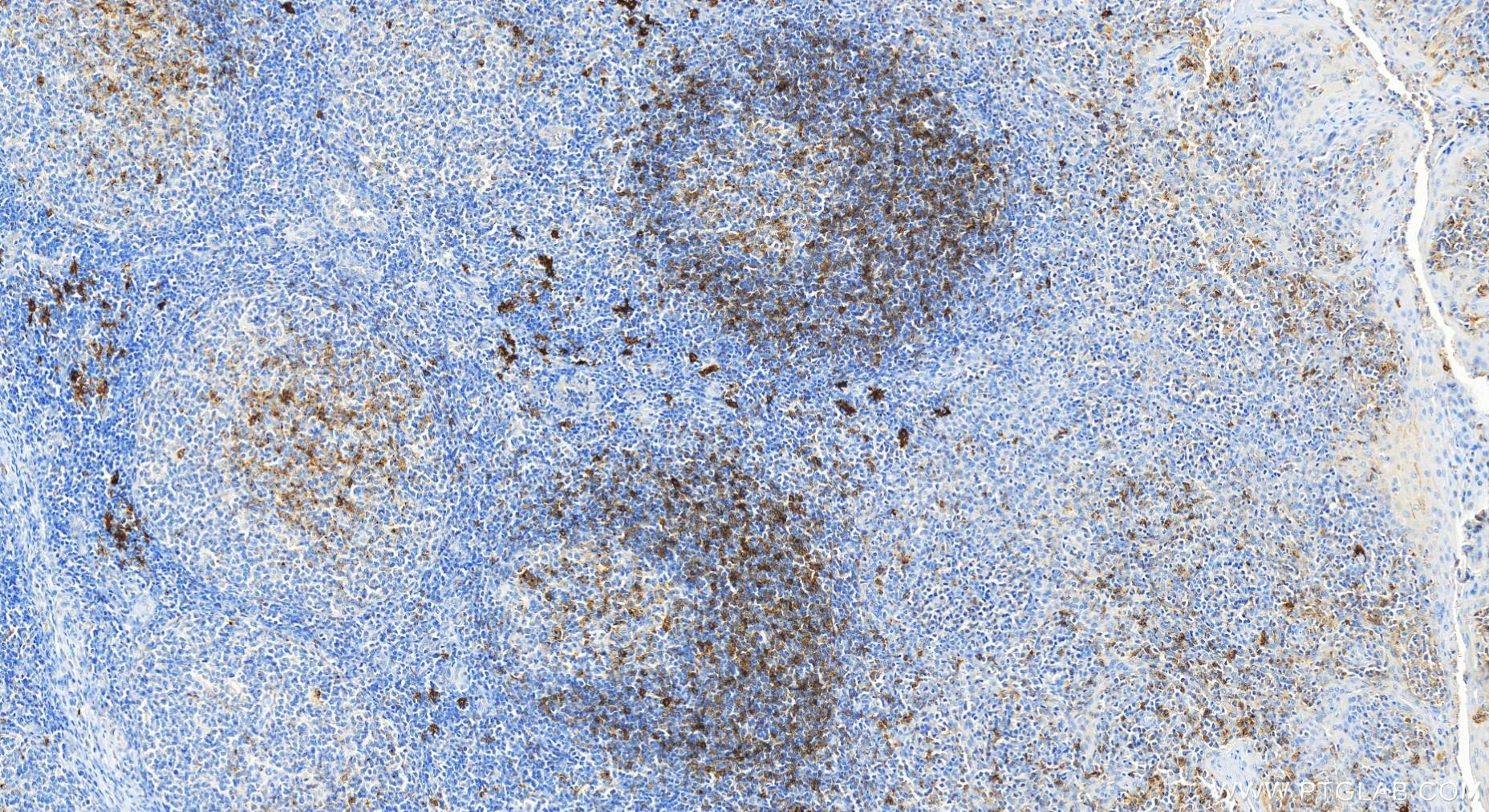 IHC staining of human tonsillitis using 27873-1-AP