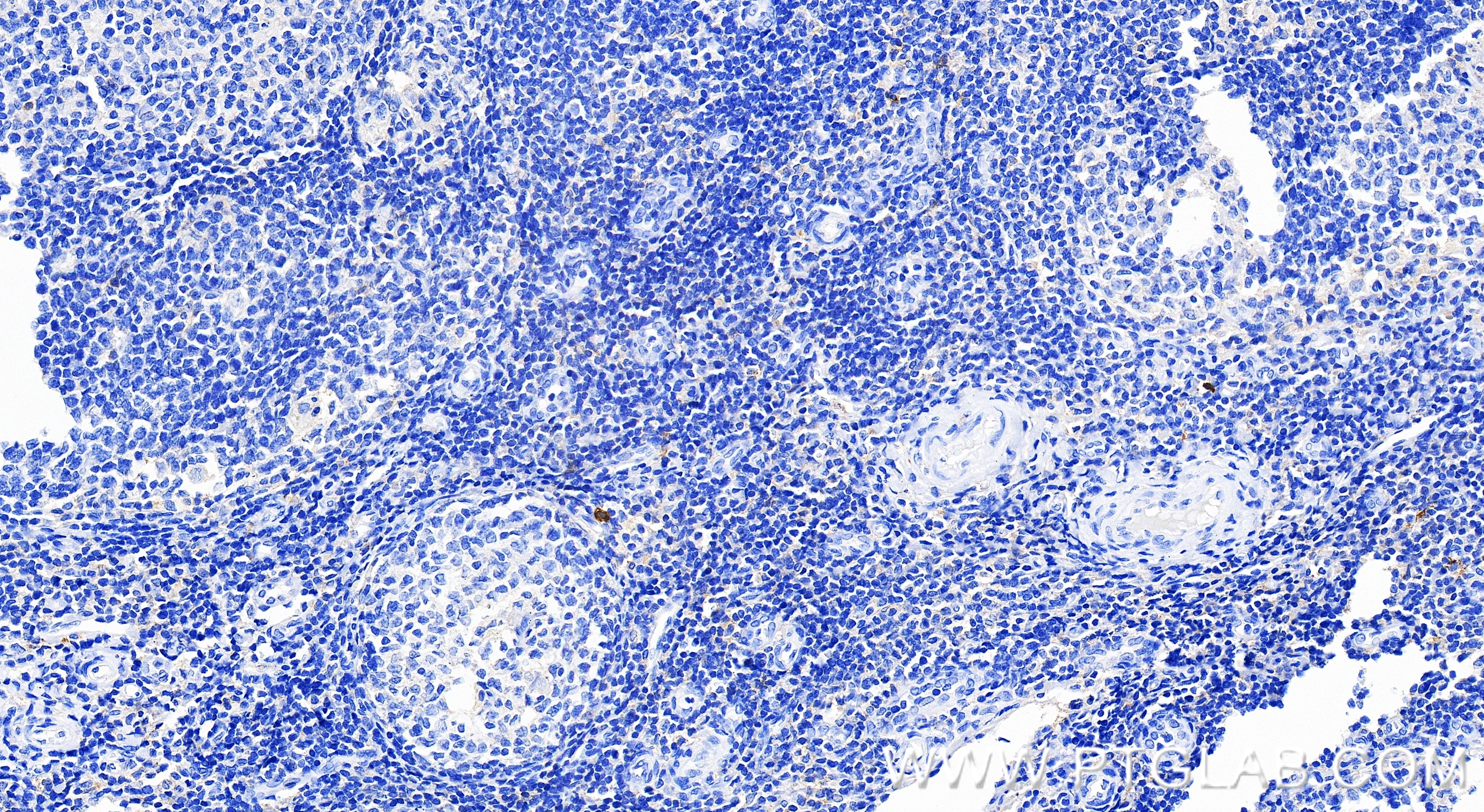 IHC staining of human tonsillitis using 98471-1-RR (same clone as 98471-1-PBS) IHC staining of human tonsillitis using 98471-1-RR (same clone as 98471-1-PBS)
