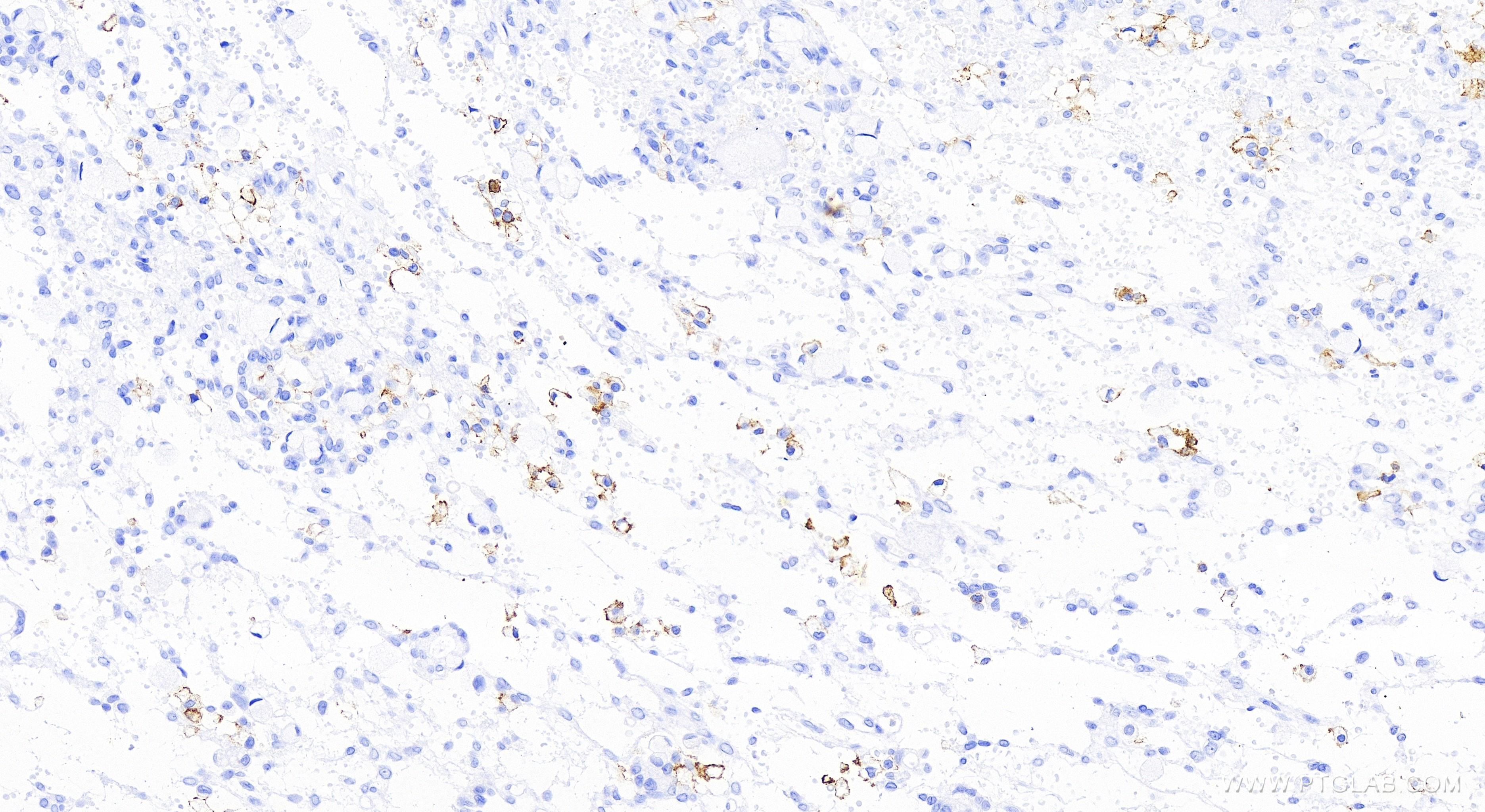 IHC staining of human ovary cancer using 83523-4-RR