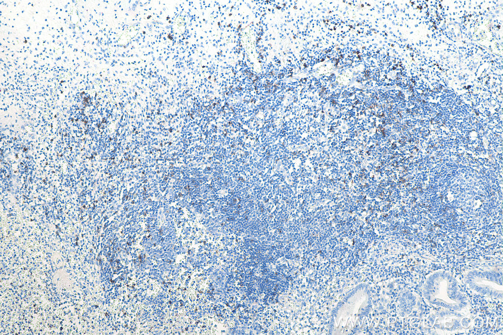 IHC staining of human appendicitis using 66868-1-Ig IHC staining of human appendicitis using 66868-1-Ig