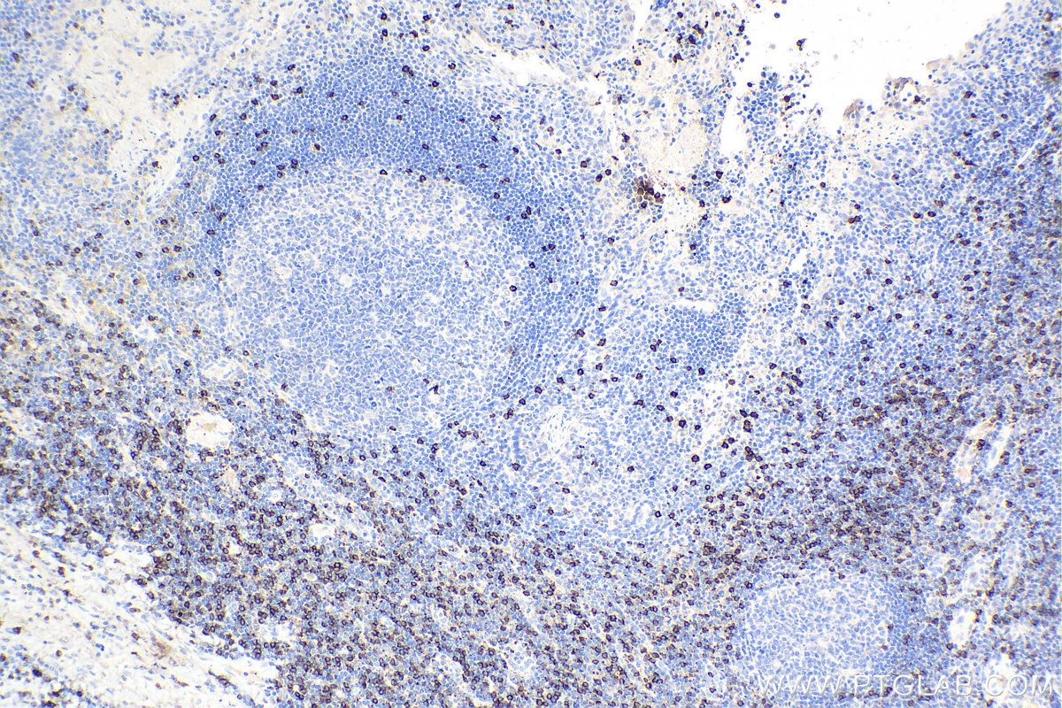 IHC staining of human tonsillitis using 66868-1-Ig