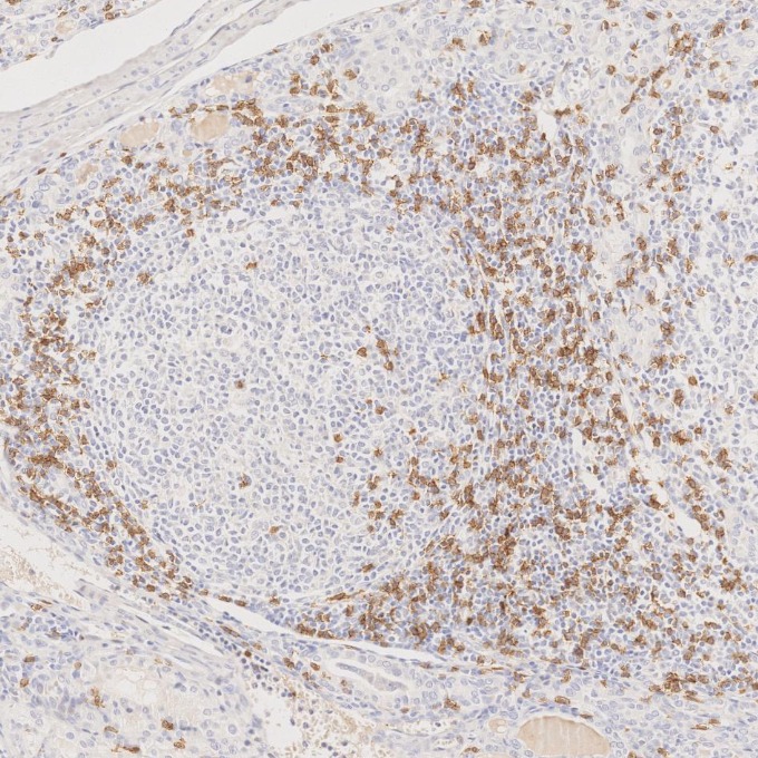 IHC staining of human lymphoma using 66868-1-Ig