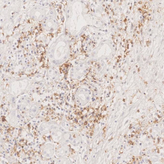IHC staining of human lymphoma using 66868-1-Ig