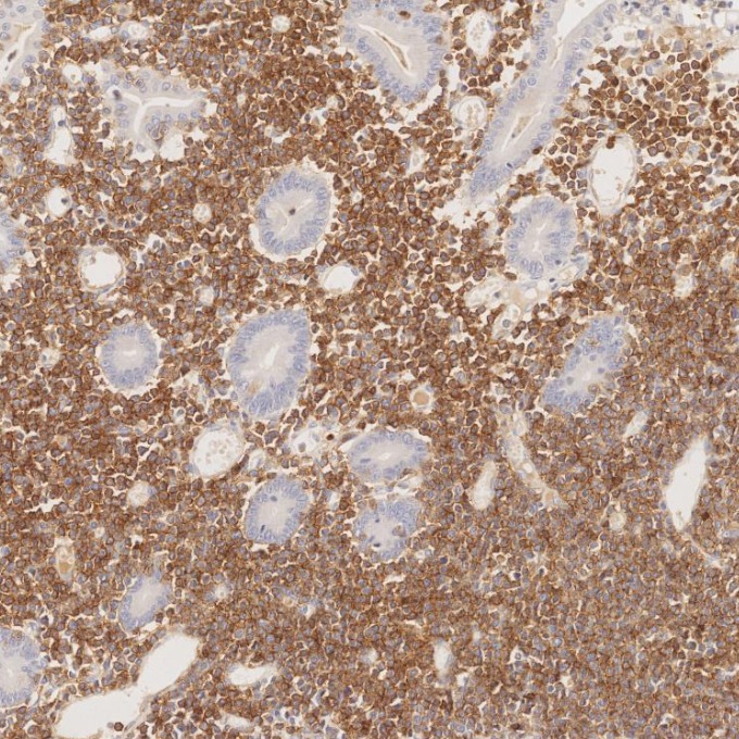 IHC staining of human lymphoma using 66868-1-Ig
