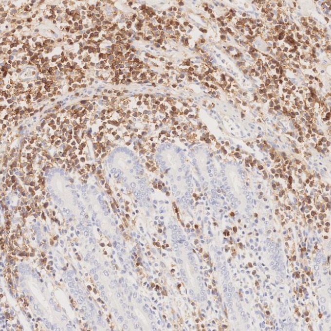 IHC staining of human lymphoma using 66868-1-Ig