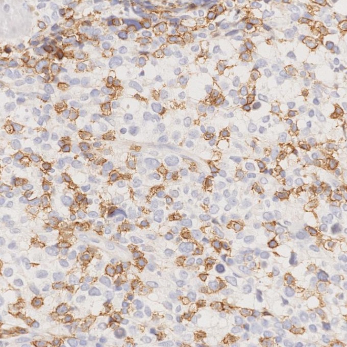 IHC staining of human lymphoma using 66868-1-Ig