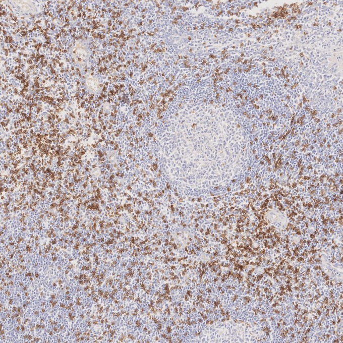 IHC staining of human tonsillitis using 66868-1-Ig