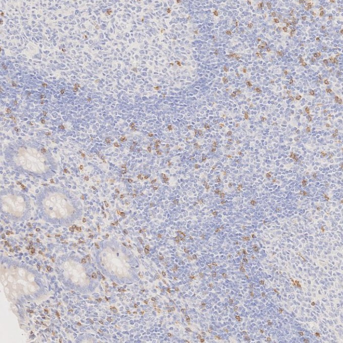 IHC staining of human appendicitis using 66868-1-Ig