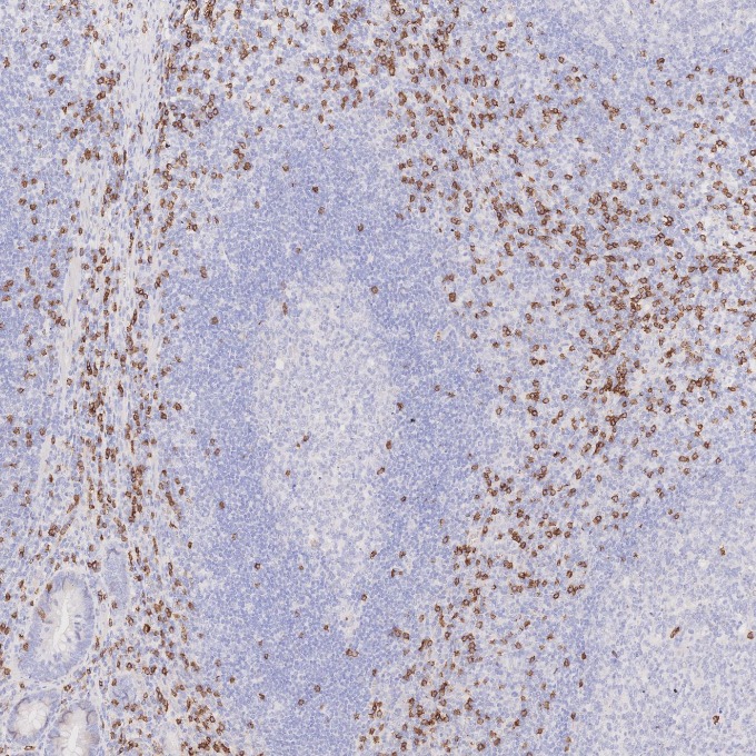 IHC staining of human appendicitis using 66868-1-Ig
