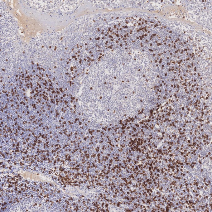 IHC staining of human tonsillitis using 66868-1-Ig