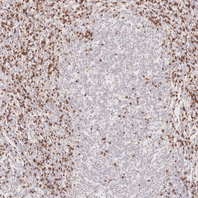 IHC staining of human lymphoma using 66868-1-Ig
