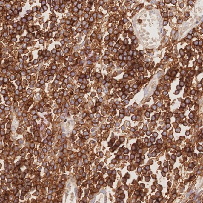 IHC staining of human lymphoma using 66868-1-Ig