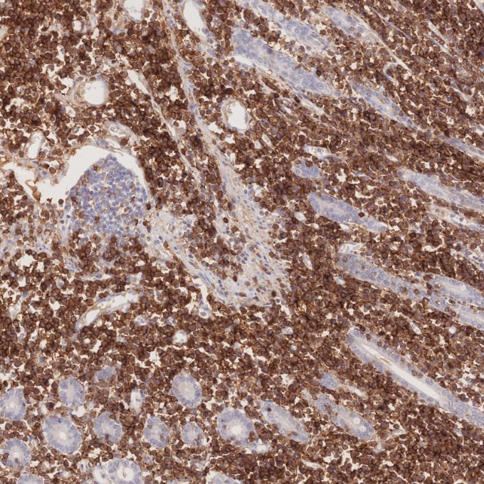 IHC staining of human lymphoma using 66868-1-Ig